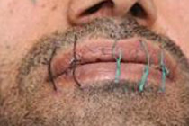 Prisoner goes on hunger strike and stitches mouth 