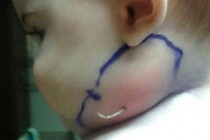 Two-inch feather emerges from baby’s cheek