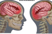 Կոնտուզիա․ Ուղեղի ցնցման ախտանշաններն ու կանխարգելիչ միջոցները