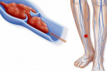 Թրոմբոֆլեբիտի զարգացումը պայմանավորող գործոններ. Ե՞րբ դիմել բժշկի