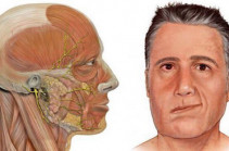 Դեմքի մկանների նյարդերի ախտահարում․Պատճառներն ու բուժումը