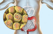 Սրատուտային վարակի՝ էնտերոբիոզի առաջացման պատճառներն ու ռիսկի գործոնները