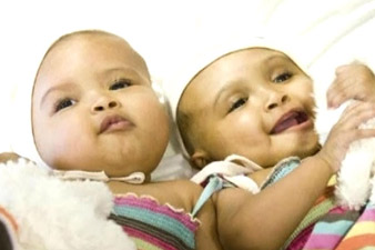 Doctors successfully separate conjoined Sudanese twins