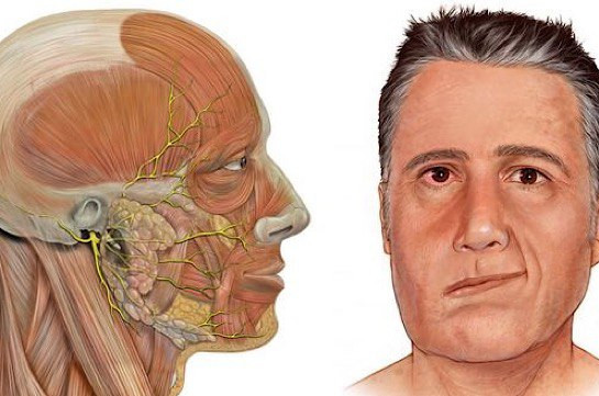 Դեմքի մկանների նյարդերի ախտահարում (կաթված). Առաջացման պատճառներն ու բուժումը