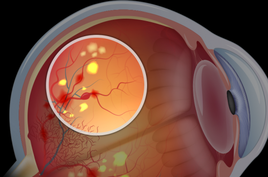 Դիաբետիկ ռետինոպաթիա․ վաղ փուլերում ախտանշաններ կարող են չլինել