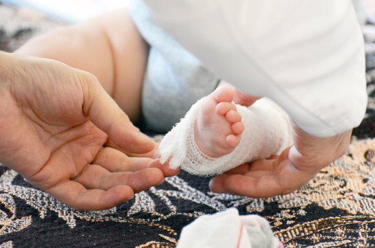 Ժառանգական մաշկախտ․  100 000 նորածիններից մեկը բուլյոզ էպիդերմոլիզով է ծնվում